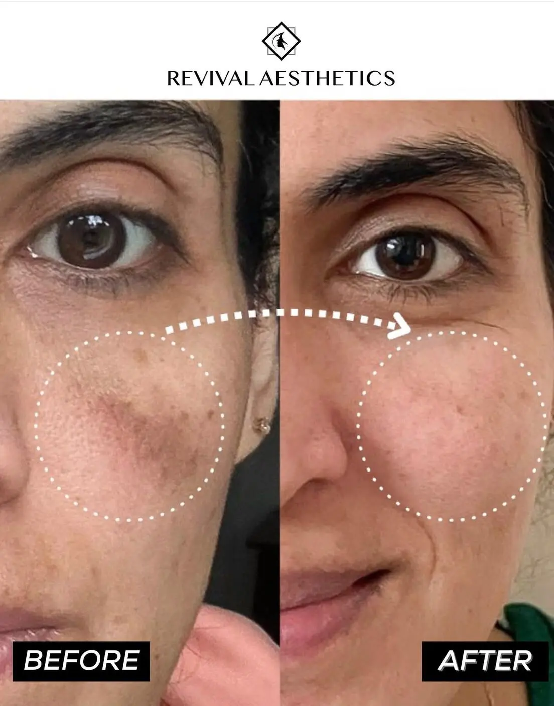 dark spots removal-skin care